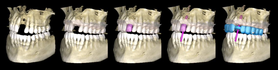 planmeca-implant-workflow.jpg