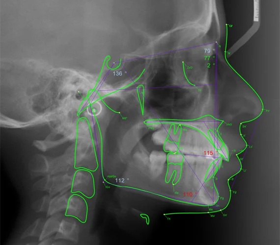 Planmeca Romexis cephalometric analysis automatic analysis