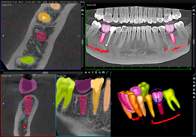 romexis-3d-implant-workflow-3.jpg