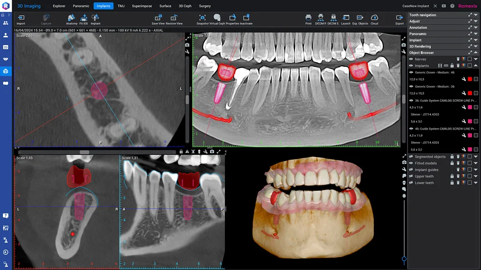 romexis-3d-implantology.jpg