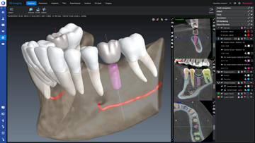 romexis-implant.jpg