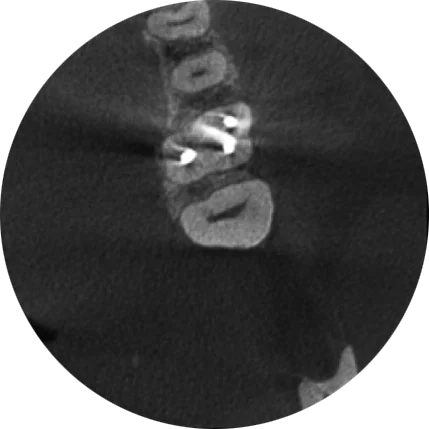 Endodontic imaging mode without ARA