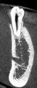 Imaging endodontic mode voxel size 75