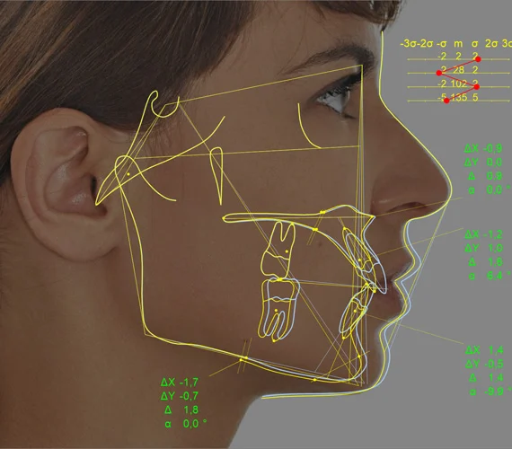 Planmeca Romexis cephalometric analysis surgical simulation