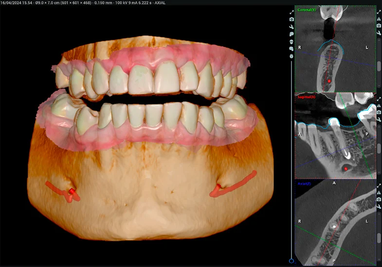 romexis-3d-implant-workflow-2.jpg